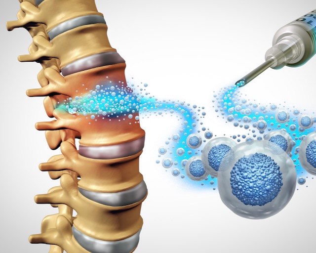 Stem Cell Back Pain as regenerative orthopedic health Medicine and Mesenchymal Cells injected for spinal joint pains to regenerate tissue repair as a medical cell therapy.